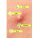 Hydrocolloid Acne Pimple Patch - 144 Fast Healing Dots | Vegan Cruelty-Free Skin Care for Zits & Blemishes - Buy Online on GoSupps.com