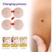 Skin Tag Removal Solution.(2PC 30ML) 2PC 30ml - Buy Online on GoSupps.com