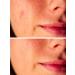 DrFormulas Foaming Face Wash for Oily Skin & Acne | Salicylic Acid Vitamin C & Tea Tree Oil - 5 oz - Buy Online on GoSupps.com