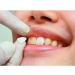 SowSmile Snap-On Smile Veneers for Instant Perfect Dental Care - Whitening Dentures - Buy Online on GoSupps.com