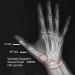 Buy Comfort Cool Thumb CMC Restriction Splint - Right Small (6 to 7) | Fast International Shipping - Buy Online on GoSupps.com