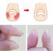Ingrown Toenail Correction Kit Ingrown Toenail Patch Correction Kit Elastic Toe Nail Straightener Patch with Nail File Glue - Buy Online on GoSupps.com