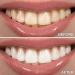 XL Teeth Whitening Pen 4cc - 20+ Uses, 44% Carbamide Peroxide Gel - Strong Stain Remover, Made in USA - Buy Online on GoSupps.com