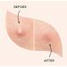 Buy Acne Pimple Healing Patch | Fast Results & Clear Impurities | Skin Perfecting Solution - International Shipping - Buy Online on GoSupps.com