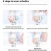 ZARADU Bunion Corrector - Free Angle Adjustment - Hallux Valgus Correction - Buy Online on GoSupps.com