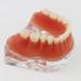 Dental Restore Model with 4 implants implant Demonstration Lower Precision Model Dental Teeth Restoration semi-Covered Prosthesis Decoration - Buy Online on GoSupps.com