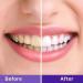 10-in-1 Teeth Whitening Kit with LED Light | Color Corrector Gel Tubes & Strips - Ultimate Smile Upgrade - Buy Online on GoSupps.com