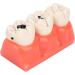 Verdant Touch Simulation Teeth Caries Model - Removable Tooth Caries Demonstration for Dental Education | International Shipping - Buy Online on GoSupps.com