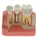 Dental Implant Interpretation Model Implant Analysis Crown Bridge Demonstration Model Teeth Model
