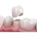 QdT Dental Cement for Crowns & Bridges - Fast-Drying Multi-Application Temporary Adhesive - Self-Cement for Capsules - Buy Online on GoSupps.com