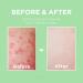 Travel-Friendly Butt Acne Treatment Cream | Clears Acne, Ingrown Hairs, Razor Bumps, and Dark Spots | Prevents Breakouts | For Butt, Thigh, and Sensitive Areas - Buy Online on GoSupps.com
