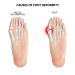 Bunion Sleeves Corrector for Men & Women - Big Toe Straightener Hallux Valgus Splint | Gel Pads & Foot Care Kit for Pain Relief (Beige - Buy Online on GoSupps.com