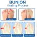 Anti-Bunion Health Socks - 5/10 Pair Strongjoints Relief Toe Socks for Women - Beige Split Toe Socks Set - Buy Online on GoSupps.com