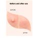 Invisible Pimple Patches - Hydrocolloid Acne Treatment for Quick Healing & Smooth Skin | 36ct (2 Sizes - Buy Online on GoSupps.com