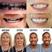 Silica Dentures Set - Upper & Lower Jaw Provisional Veneer Teeth Prosthesis | Quick Repair for Confident Smile - 5 Pairs - Buy Online on GoSupps.com