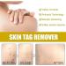 (Must - Have) Super Luxe Skin Re_mover Super Luxe Skin Re_moval Skin Tag Re_mover Cream Painless Mole and Skin Re_mover for All Skin Types (2PC) - Buy Online on GoSupps.com