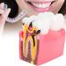 Buy Caries Comparison Study Models | Dental Anatomy Teeth Models for Dentist Education - International Shipping - Buy Online on GoSupps.com