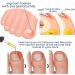 Ingrown Toenail Correction Oil - Drops - Softener for Easy Trimming | Type A - Buy Online on GoSupps.com