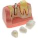 Samnuerly Dental Implant Model - 4-Way Analysis & Crown Bridge Demo for Training | International Shipping Available - Buy Online on GoSupps.com
