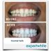 QuickGlo Rapid 35% Carbamide Peroxide Teeth Whitening Gel - Dentist Grade Refill Syringes (4x3cc) for Fast White Teeth - Made in USA - Buy Online on GoSupps.com