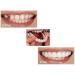 Buy Instant Cosmetic Dentures - 2 Pairs Temporary Veneer Teeth for Upper & Lower | Comfort Fit One Size 111 - Worldwide Shipping - Buy Online on GoSupps.com