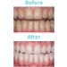 Teeth Whitening Gel Syringe Refill; 2 Syringes of 3 ml Gel. Powered by Novon Technology (10% Carbamide Peroxide) - Buy Online on GoSupps.com