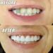 Iksvmsi Prostheses: High-Quality False Teeth & Temporary Dentures for Men - 1 Pair of Veneers for Bad Teeth - Buy Online on GoSupps.com