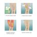 Varicose Veins Patch - Effective Treatment for Spider Veins | 12 Pcs | Fast International Shipping - Buy Online on GoSupps.com