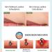 Razor Bump and Ingrown Hairs Serum - After Shave Solution Roll-On for Ingrown Hairs Razor Burns and Razor Bumps for Men and Women - Buy Online on GoSupps.com