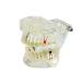 Denshine Dental Implant Disease Teeth Model with Restoration & Bridge Tooth