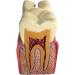 Colcolo Teeth Model - 6X Caries Comparison Examination Models for Study & Research | International Shipping Available - Buy Online on GoSupps.com