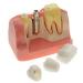 Dental Implant Analysis Demonstration Model - Crown Bridge Teeth Interpretation Model - Buy Online on GoSupps.com