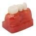 Verdant Touch Crown Bridge Demonstration model Dental implant model 4 times crown bridge implant teeth demonstration doctor-patient education