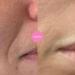 Notox Mouth + Smile Lines - Nudie Face 100% Medical Grade Silicone Wrinkle Patches | Reusable Silicone Patches To Reduce Mouth and Smile Lines | Fine Line & Wrinkle Reduction | Fast Results - Buy Online on GoSupps.com