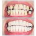 Buy WTTFC Couples False Teeth Veneers | Cosmetic Provisional Dentures for Men & Women - International Shipping - Buy Online on GoSupps.com