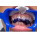LaserGlow Purple Toothpaste | #1 Color Corrector for Whitening & Stain Removal | Best Purple Toothpaste for Yellow Tones - Buy Online on GoSupps.com