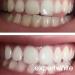 44 Teeth Whitening Gel Refills - USA Made Carbamide Peroxide - 4 Syringes (3 cc each) for Custom Dental Trays - Fast International Shipping - Buy Online on GoSupps.com