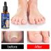 3Pcs German Toenailcare Removal Paronychia Oil for Healthier Toenails - Buy Online on GoSupps.com