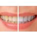 Starlite Smile Teeth Whitening Accelerator Light - 16x Powerful Blue LED Teeth Whitening Machine for Home Use - Compatible with iPhone/Android/USB-C - Teeth Whitener Gum Tray - Buy Online on GoSupps.com