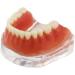 Dental Restore Model with 4 implants implant Demonstration Lower Precision Model Dental Teeth Restoration semi-Covered Prosthesis Decoration - Buy Online on GoSupps.com