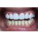 SowSmile Snap-On Smile Veneers for Instant Perfect Dental Care - Whitening Dentures - Buy Online on GoSupps.com