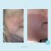 Hydra-Repair Wrinkle Cream with Matrixyl 3000 & Hyaluronic Acid - Anti-Aging Post-Peel Treatment - Buy Online on GoSupps.com