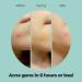 UVA Lifestyle Acne Patches Effective Pimple & Spot Treatment with Salicylic Acid | International Shipping Available - Buy Online on GoSupps.com