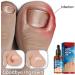 German Toenailcare Paronychia & Bunion Relief Oil for Thick, Discolored Nails - 1Pcs - Buy Online on GoSupps.com