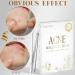 252 PCs 2-in-1 Acne Pimple Patch - Day & Night Acne Treatment for Fast Healing - Buy Online on GoSupps.com