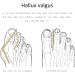 Gel Toe Separators - Correct Overlapping Toes - Hallux Valgus Foot Care Tools - Buy Online on GoSupps.com