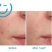 Kate Somerville EradiKate Blemish Treatment Blemish Remover Clears Blemishes Spots and Breakouts 30ml - Buy Online on GoSupps.com
