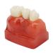 Dental implant model - 4 times enlargement demonstration model for crown bridge implant teeth - comparison of the recovery effect