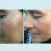Lactic 50% Gel Peel - Chemical Exfoliant for Face Remove Breakout Scars Strength Level 2 1 oz - Perfect Image - Buy Online on GoSupps.com