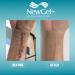NewGel+ Advanced Silicone Scar Treatment Tape for Abdomen & Extremity - REUSABLE - Clear - Buy Online on GoSupps.com
